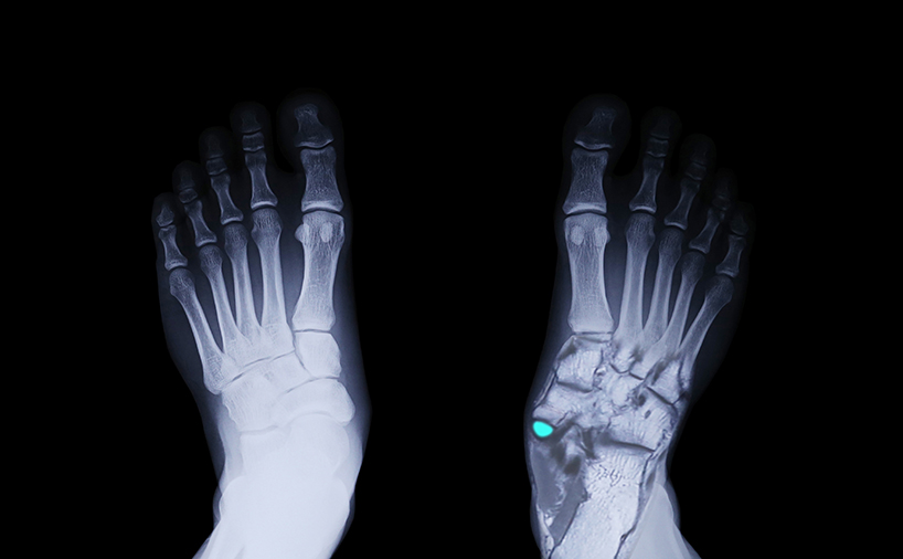 voxel harvest project creates innovative orthotic care devices through metamaterial programming