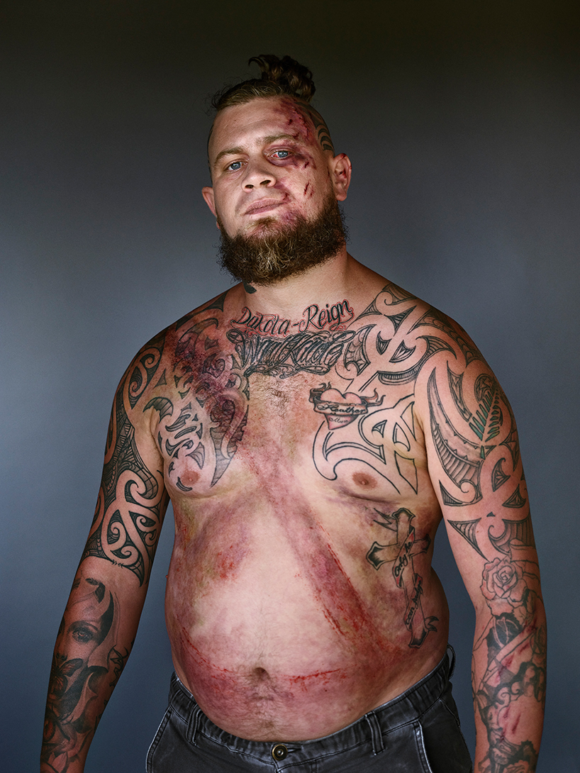 the 'belted survivor' series transforms real seatbelt wounds into badges of honour designboom