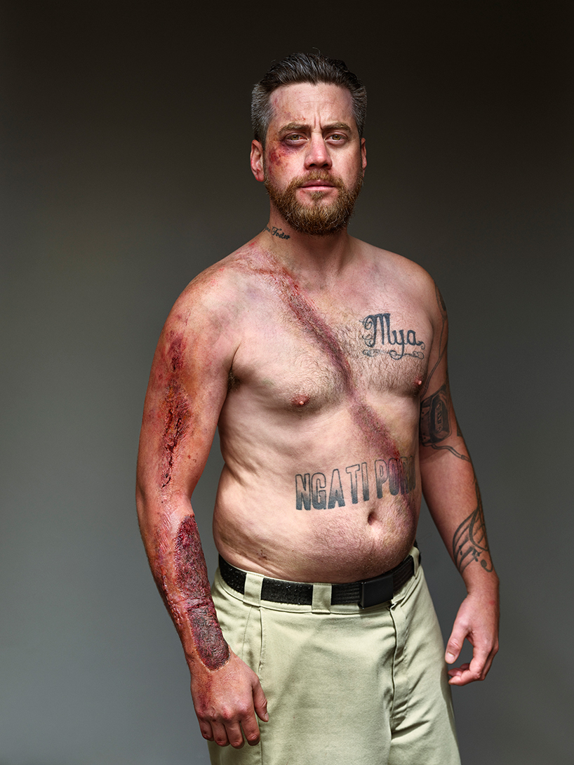 the 'belted survivor' series transforms real seatbelt wounds into badges of honour designboom