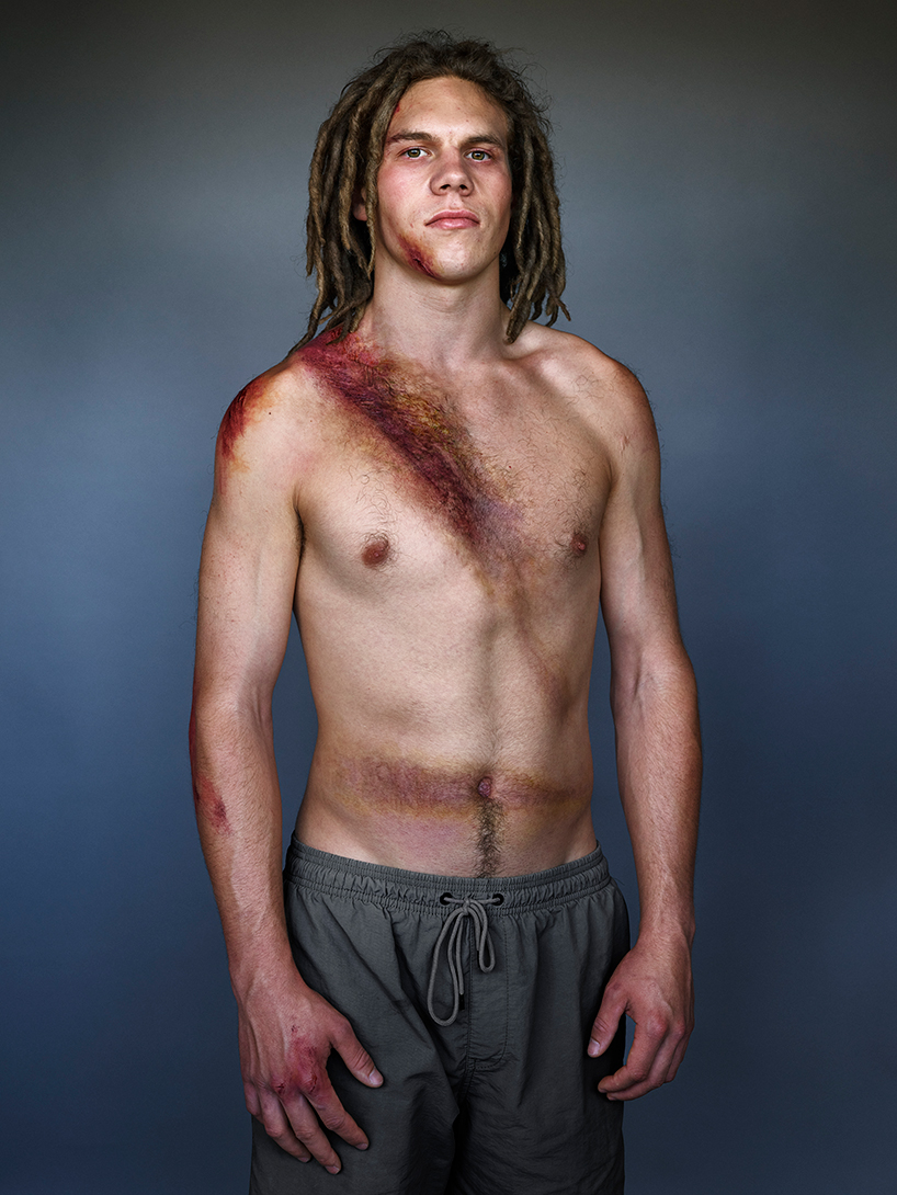 the 'belted survivor' series transforms real seatbelt wounds into badges of honour designboom