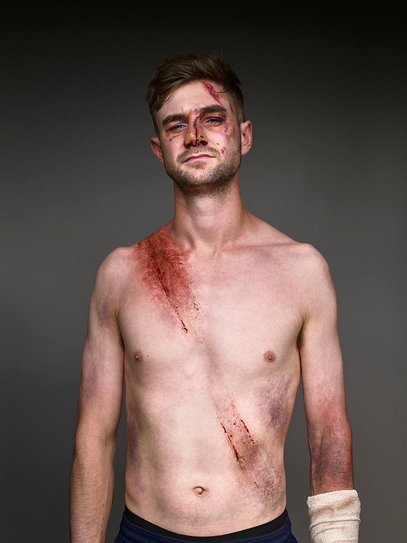 the 'belted survivor' series transforms real seatbelt wounds into badges of honour designboom