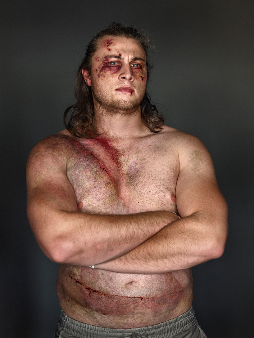 the 'belted survivor' series transforms real seatbelt wounds into badges of honour designboom