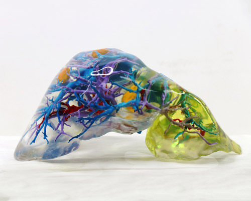 3D printed liver models identify patient-specific anatomies