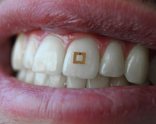scientists developed a golden sticker for your tooth to track how much you eat