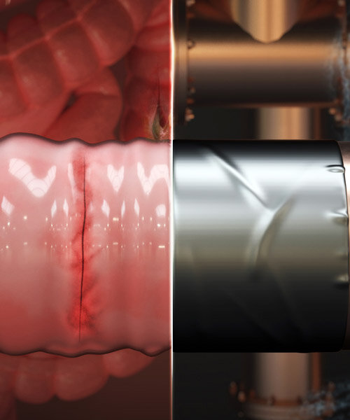 MIT engineers develop surgical ‘duct tape’ for sutures and operations