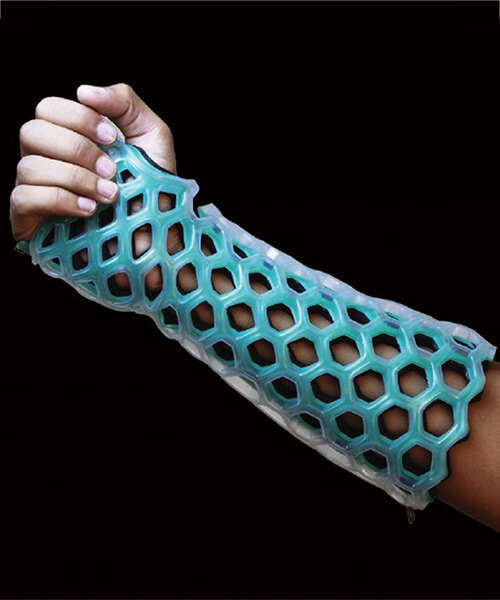washable and breathable 'flexiOH' orthopedic cast is removed with a zipper